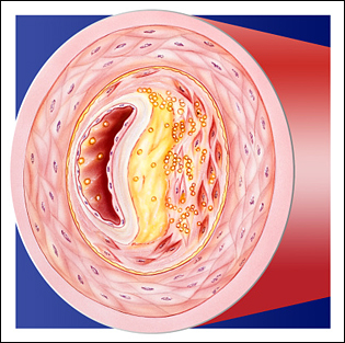 cholesterol
